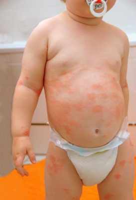 Пустулезные элементы у детей при псориазе обычно располагаются на теле и конечностях