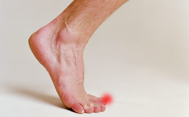 Основная причина появления шишки на ноге