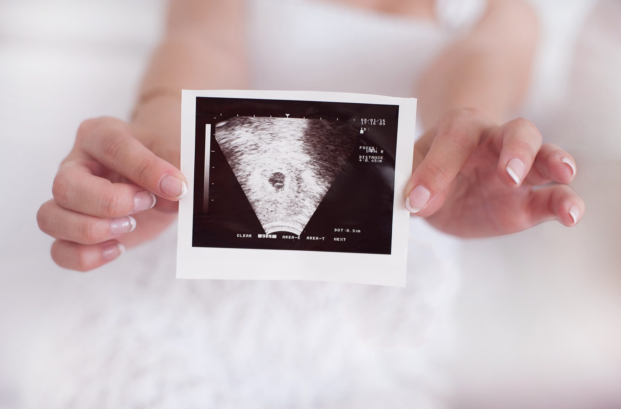 Можно ли делать часто узи при беременности. Снимок УЗИ на беременность 1 ребенок. Снимок УЗИ первый скрининг. 1 Триместр беременности снимки УЗИ.